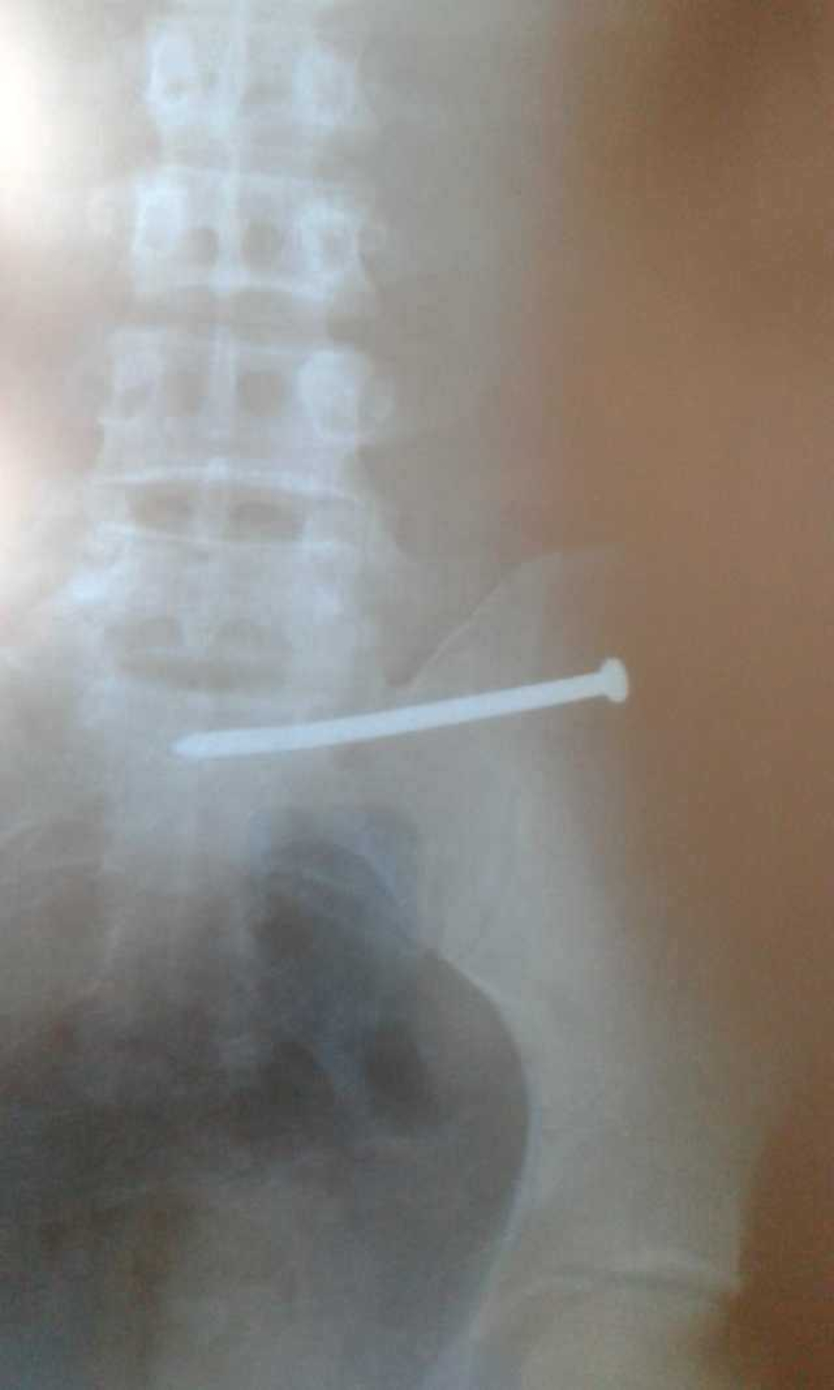 Homem engole prego e vai parar no hospital (Imagem: Via Lagarto Como Eu Vejo)