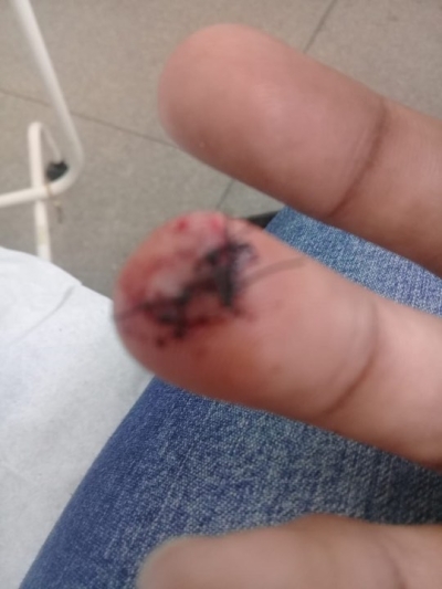 Banhista é atacado por piranha no Rio São Francisco (Foto: Via Pingou Notícias)
