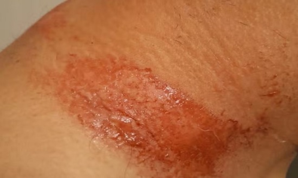 Inquérito é aberto para apurar queimaduras em foliões de Ribeirópolis - Foto: Reprodução | Redes Sociais