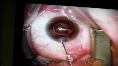 Mutirão de cirurgias de cataras em Estância devolve qualidade de vida a pacientes (Foto: SES/SE)