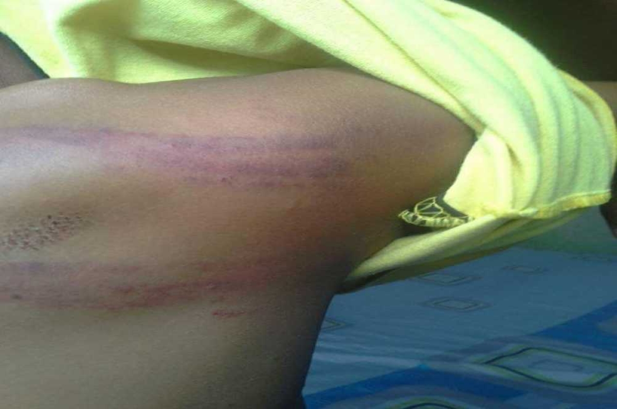 A criança ficou com hematomas por todo corpo (Foto: Reprodução/ WhatsApp/ JP & Ana Informações/ Via Portal Infonet)
