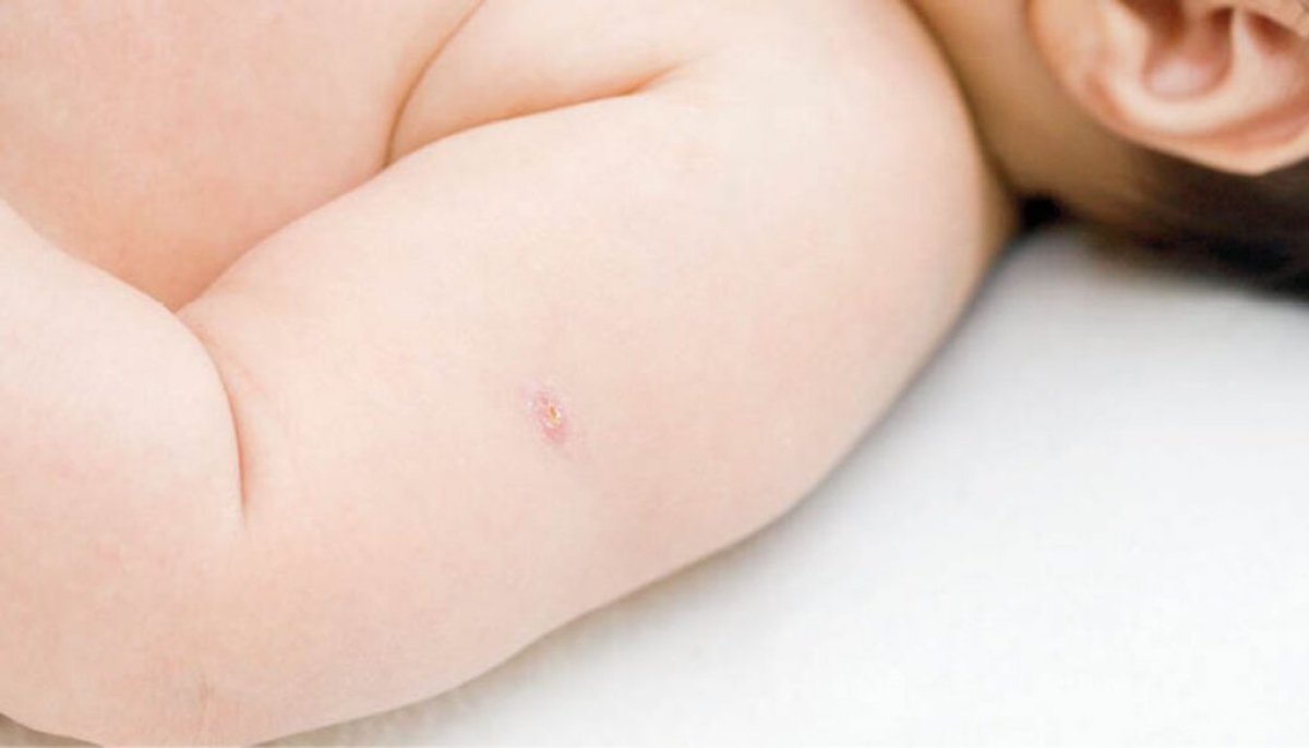 Vacina BCG: saúde reforça a necessidade de imunização dos bebês contra as formas graves de tuberculose pulmonar (Foto: SES/SE)