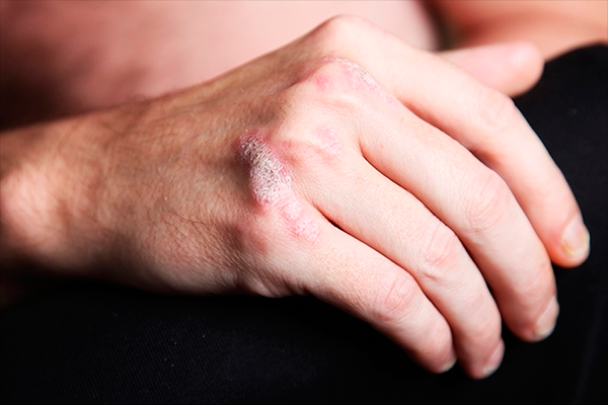Pouco se sabe sobre esta doença, que ao afetar principalmente a pele, causa fibrose e compromete o funcionamento e até mesmo o crescimento da área afetada - Foto: Reprodução/Sociedade Mineira de Reumatologia
